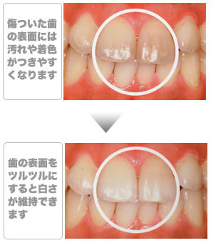 歯のトリートメントサプリ